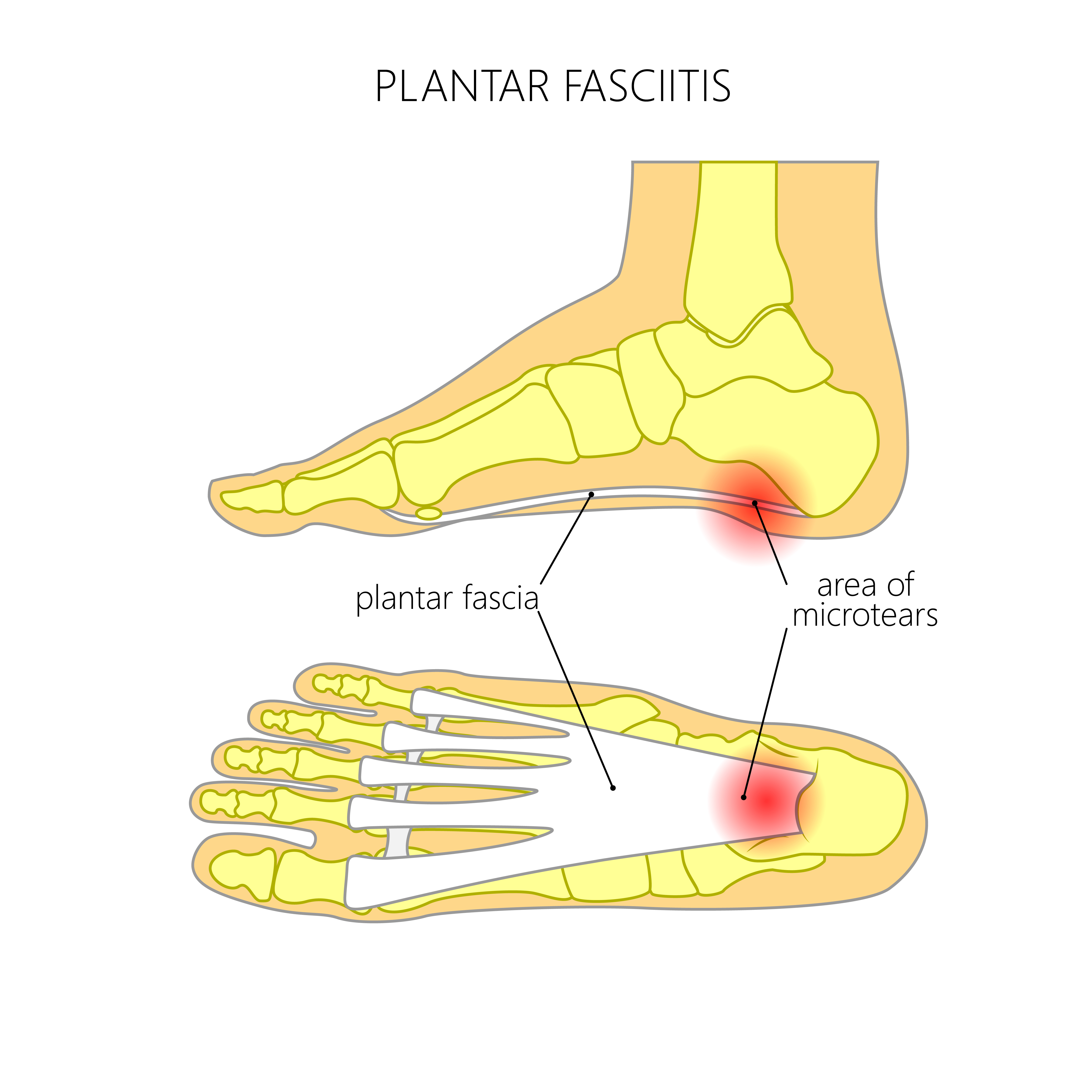 Is there a treatment for plantar fasciitis?