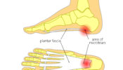 plantar fasciitis